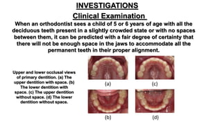 Serial extraction of class i malocclusion
