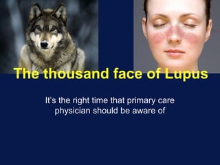 It’s the right time that primary care
physician should be aware of
The thousand face of Lupus
 