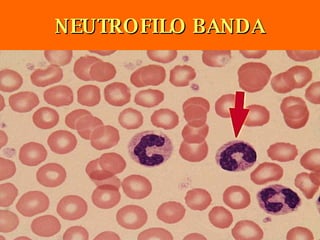NEUTROFILO BANDA 