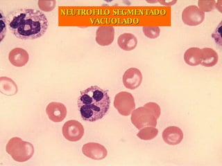 NEUTROFILO SEGMENTADO  VACUOLADO 