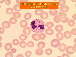 NEUTROFILO SEGMENTADO  VACUOLADO 