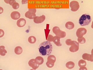 NEUTROFILO ANOMALIA CUERPO-DOHLE 