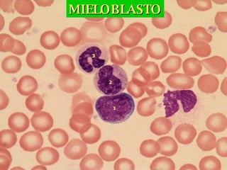 MIELOBLASTO 