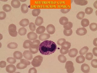 NEUTROFILO CON  GRANULACION TOXICA 