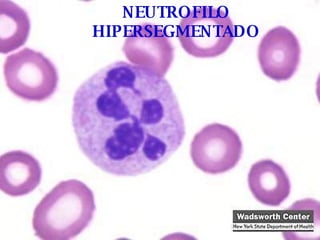 NEUTROFILO HIPERSEGMENTADO 