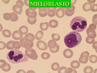MIELOBLASTO 