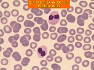 NEUTROFILO ANOMALIA PELGER-HUET 