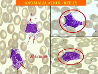 ANOMALIA ALDER -REILLY 