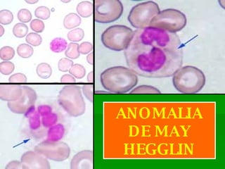 ANOMALIA DE MAY HEGGLIN 