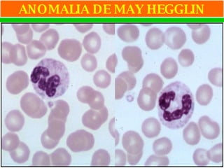 ANOMALIA DE MAY HEGGLIN 