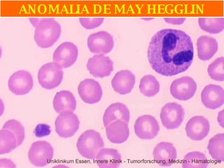 ANOMALIA DE MAY HEGGLIN 
