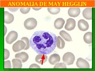 ANOMALIA DE MAY HEGGLIN 