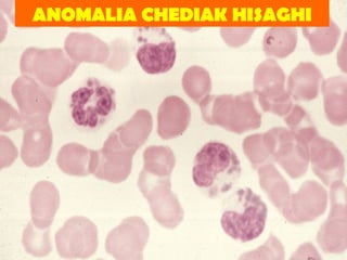ANOMALIA CHEDIAK HISAGHI 