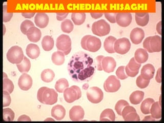 ANOMALIA CHEDIAK HISAGHI 