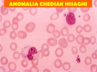 ANOMALIA CHEDIAK HISAGHI 