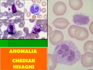 ANOMALIA  CHEDIAK HISAGHI 