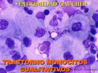 ENFREMEDAD GAUCHER TRASTORNO MONOCITOS CUALITATIVOS 