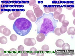 TRASTORNOPS NO MALIGNODE LINFOCITOS CUANTITATIVOS ADQUIRIDOS MONONUCLEOSIS INFECCIOSA 