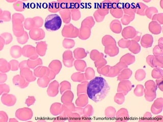 MONONUCLEOSIS INFECCIOSA 