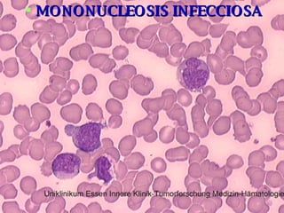 MONONUCLEOSIS INFECCIOSA 