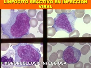 LINFOCITO REACTIVO EN INFECCION VIRAL MONONUCLEOSIS INFECCIOSA 