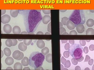 LINFOCITO REACTIVO EN INFECCION VIRAL 