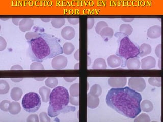 LINFOCITO REACTIVO EN INFECCION POR CMV 
