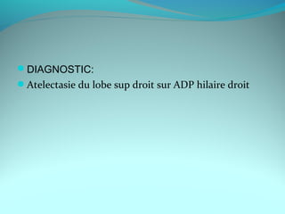 DIAGNOSTIC:
Atelectasie du lobe sup droit sur ADP hilaire droit
 