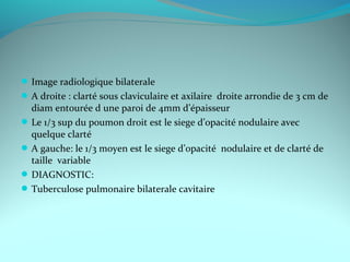 Image radiologique bilaterale
A droite : clarté sous claviculaire et axilaire droite arrondie de 3 cm de
diam entourée d une paroi de 4mm d’épaisseur
Le 1/3 sup du poumon droit est le siege d’opacité nodulaire avec
quelque clarté
A gauche: le 1/3 moyen est le siege d’opacité nodulaire et de clarté de
taille variable
DIAGNOSTIC:
Tuberculose pulmonaire bilaterale cavitaire
 