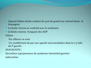 Opacité hilaire droite ovalaire de 4cm de grand axe vertical dense et
homogene
La limite interne se confond avec le mediastin
la limite externe évoquant des ADP
Hilaire
Par ailleurs on note
Un comblement de par une opacité micronodulaire dans le 1/3 infer
du P gauche
DIAGNOSTIC:
Sarcoidose type(presence de syndrome interstitiel gauche)
tuberculose
 