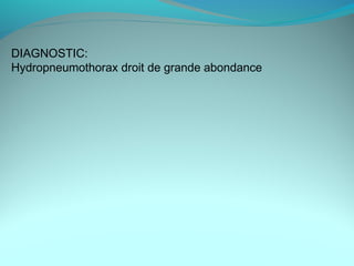 DIAGNOSTIC:
Hydropneumothorax droit de grande abondance
 