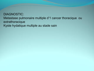 DIAGNOSTIC:
Metastase pulmonaire multiple d’1 cancer thoracique ou
extrathoracique
Kyste hydatique multiple au stade sain
 