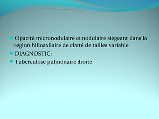 Opacité micronodulaire et nodulaire siégeant dans la
région hilloaxilaire de clarté de tailles variable
DIAGNOSTIC:
Tuberculose pulmonaire droite
 