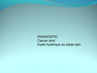 DIAGNOSTIC:
Cancer droit
Kyste hydarique au stade sain
 
