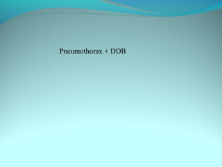 Pneumothorax + DDB
 