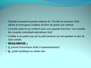 Opacité occupant la partie externe du 1/3 infer du poumon droit
dense et homogene ovalaire de 8cm de grand axe vertical
La limite externe se confend avec une opacité d’environ 1cm comble
les coupole costodiaphragmatique droit
Limitée a sa partie sup par la petit sessure qui est epaisse et pas de
lyse costale
 DIAGNOSTIC :DIAGNOSTIC :
 1_1_cancer bronchique droit( d epaississement)
 2_2_ kyste hydatique au stade sain
 
