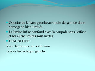 Opacité de la base gauche arrondie de 5cm de diam
homogene bien limités
La limite inf se confond avec la coupole sans l efface
et les autre limites sont nettes
DIAGNOSTIC:
kyste hydatique au stade sain
cancer bronchique gauche
 