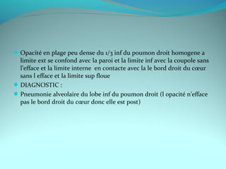 Opacité en plage peu dense du 1/3 inf du poumon droit homogene a
limite ext se confond avec la paroi et la limite inf avec la coupole sans
l’efface et la limite interne en contacte avec la le bord droit du cœur
sans l efface et la limite sup floue
DIAGNOSTIC :
Pneumonie alveolaire du lobe inf du poumon droit (l opacité n’efface
pas le bord droit du cœur donc elle est post)
 