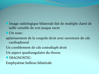 Image radiologique bilaterale fait de multiple clarté de
taille variable de 1cm jusque 10cm
On note:
aplatissement de la coupole droit avec ouverture de cds
cardiopleural
Un comblement de cds costodiaph droit
Un aspect quadrangulaire du thorax
DIAGNOSTIC:
Emphysème bulleux bilatérale
 