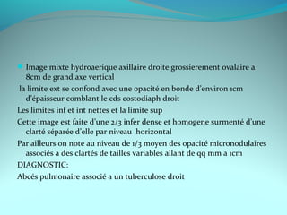 Image mixte hydroaerique axillaire droite grossierement ovalaire a
8cm de grand axe vertical
la limite ext se confond avec une opacité en bonde d’environ 1cm
d’épaisseur comblant le cds costodiaph droit
Les limites inf et int nettes et la limite sup
Cette image est faite d’une 2/3 infer dense et homogene surmenté d’une
clarté séparée d’elle par niveau horizontal
Par ailleurs on note au niveau de 1/3 moyen des opacité micronodulaires
associés a des clartés de tailles variables allant de qq mm a 1cm
DIAGNOSTIC:
Abcés pulmonaire associé a un tuberculose droit
 