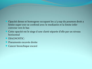 Opacité dense et homogene occupant les 2/3 sup du poumon droit a
limite super extr se confond avec le mediastin et la limite infer
convexe vers le bas
Cette opacité est le siege d une clarté séparée d’elle par un niveau
horizontal
DIAGNOSTIC:
Pneumonie excavée droite
Cancer bronchique excavé
 