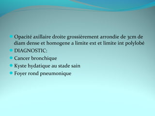 Opacité axillaire droite grossièrement arrondie de 3cm de
diam dense et homogene a limite ext et limite int polylobé
DIAGNOSTIC:
Cancer bronchique
Kyste hydatique au stade sain
Foyer rond pneumonique
 