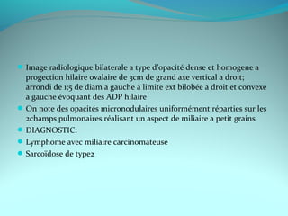 Image radiologique bilaterale a type d’opacité dense et homogene a
progection hilaire ovalaire de 3cm de grand axe vertical a droit;
arrondi de 1;5 de diam a gauche a limite ext bilobée a droit et convexe
a gauche évoquant des ADP hilaire
On note des opacités micronodulaires uniformément réparties sur les
2champs pulmonaires réalisant un aspect de miliaire a petit grains
DIAGNOSTIC:
Lymphome avec miliaire carcinomateuse
Sarcoïdose de type2
 