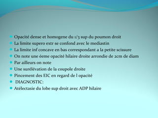 Opacité dense et homogene du 1/3 sup du poumon droit
La limite supero extr se confond avec le mediastin
La limite inf concave en bas correspondant a la petite scissure
On note une éeme opacité hilaire droite arrondie de 2cm de diam
Par ailleurs on note
Une surélévation de la coupole droite
Pincement des EIC en regard de l opacité
 DIAGNOSTIC:
Atélectasie du lobe sup droit avec ADP hilaire
 