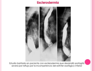 Estudio baritado en paciente con esclerodermia que desarrolló esofagitis
   severa por reflujo por la incompetencia del esfínter esofágico inferior
 
