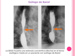 La SEGD muestra una estenosis concéntrica (flecha) en el tercio
    esofágico medio en un paciente con esófago de Barret
 