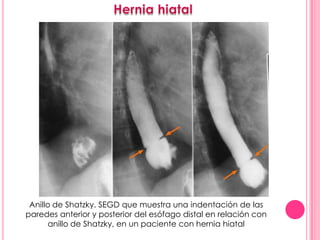 Anillo de Shatzky. SEGD que muestra una indentación de las
paredes anterior y posterior del esófago distal en relación con
       anillo de Shatzky, en un paciente con hernia hiatal
 
