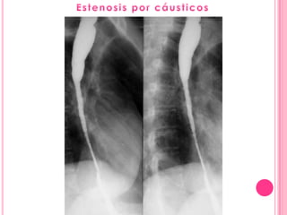 Serie esofagogastroduodenal