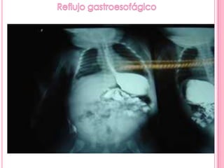 Serie esofagogastroduodenal