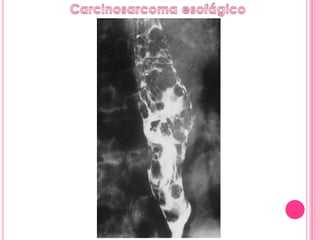 Serie esofagogastroduodenal